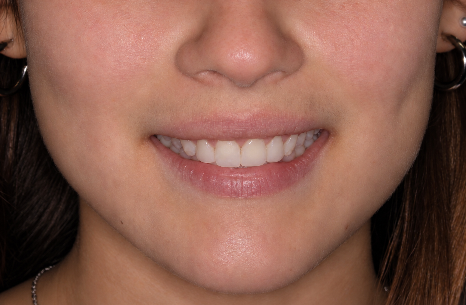 Resultado clínico de carillas dentales