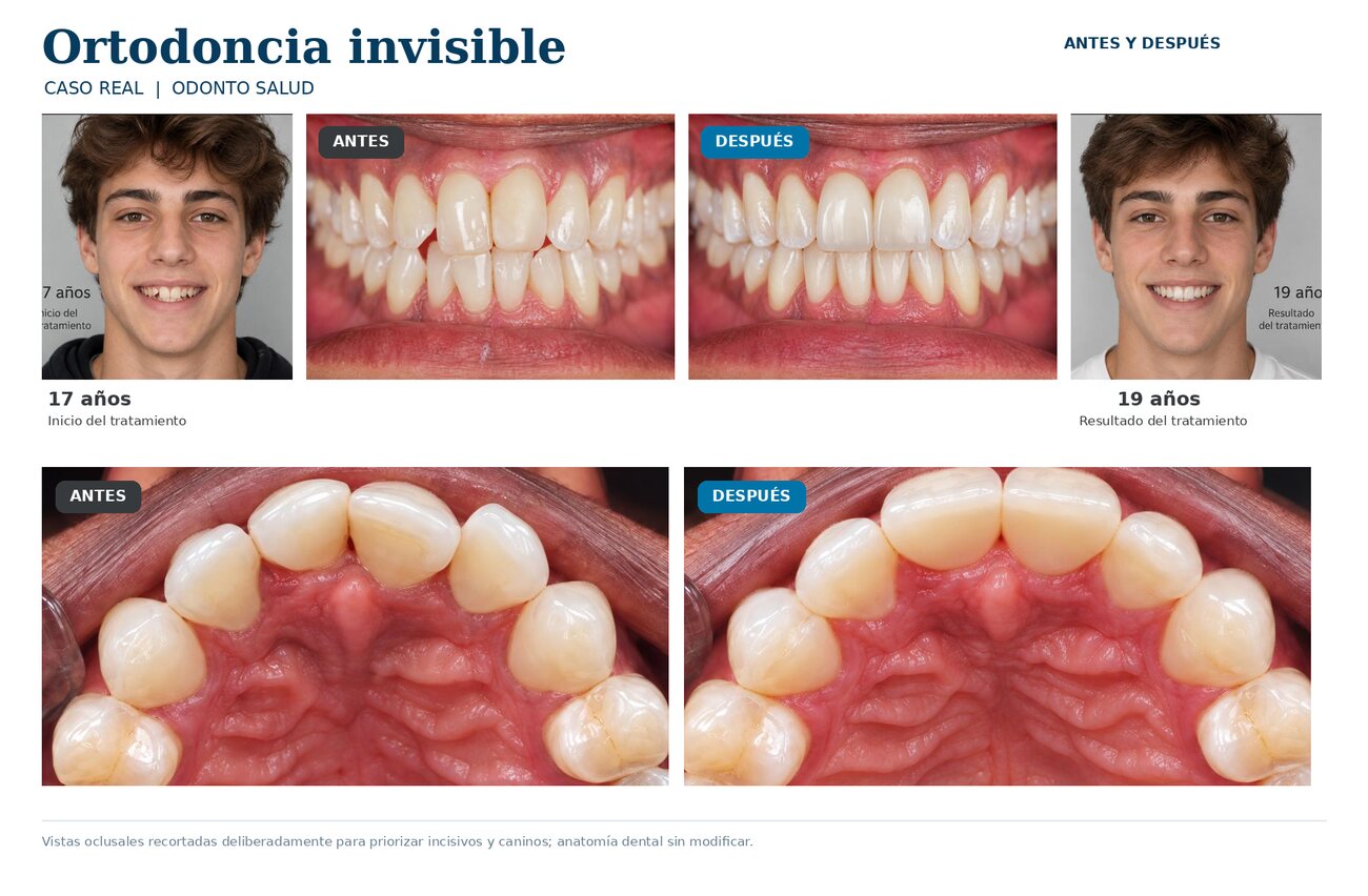 Caso clínico real de ortodoncia invisible con vistas frontales y oclusales, antes y después