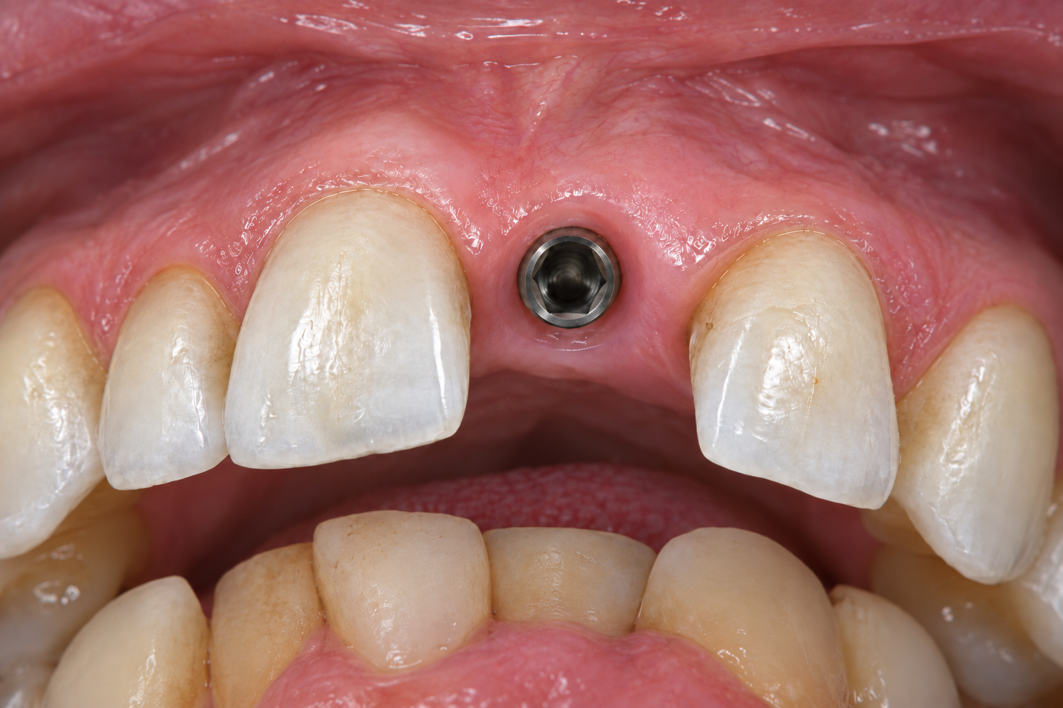 Vista oclusal de un implante con conexión interna